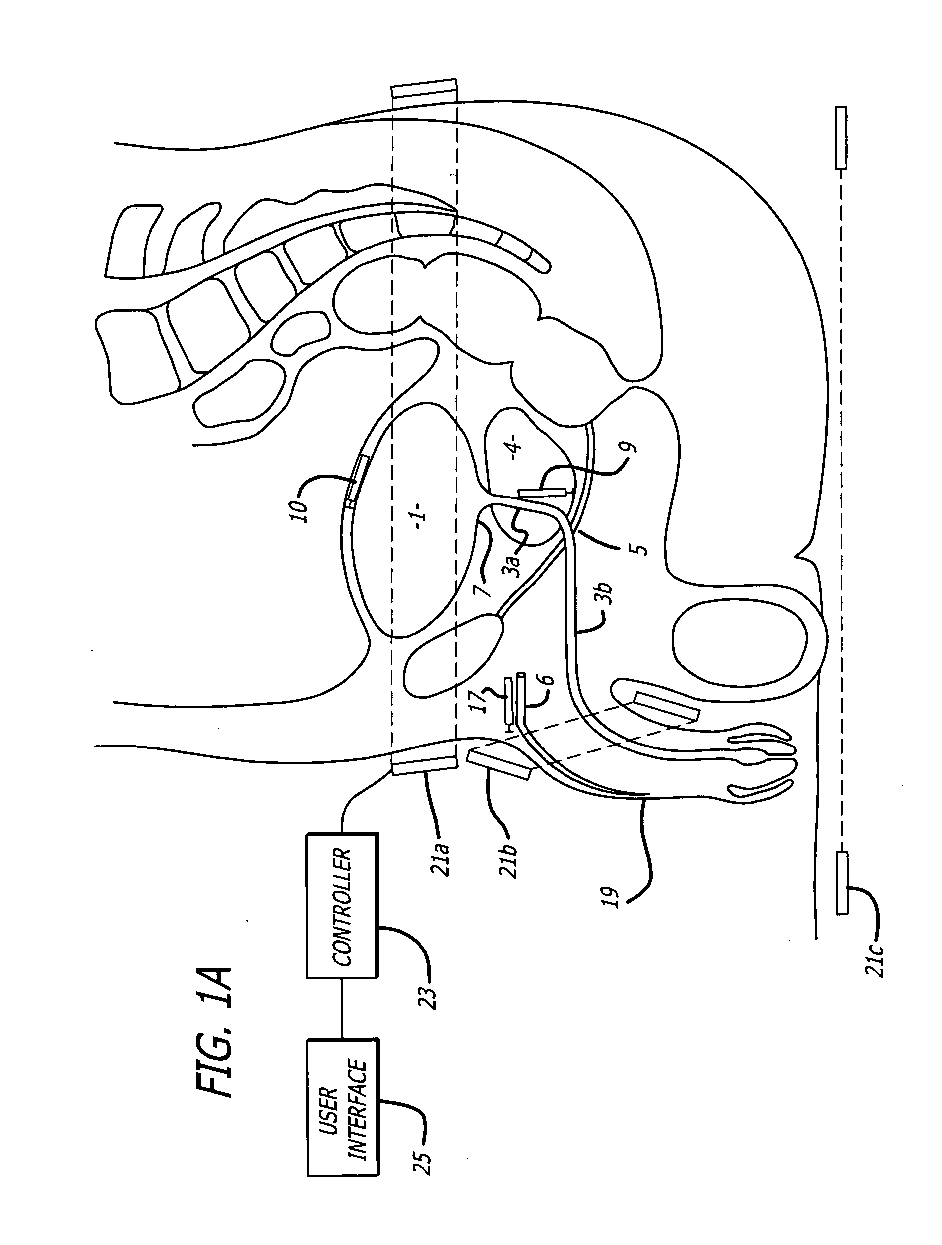 Method and apparatus for the treatment of urinary tract dysfunction