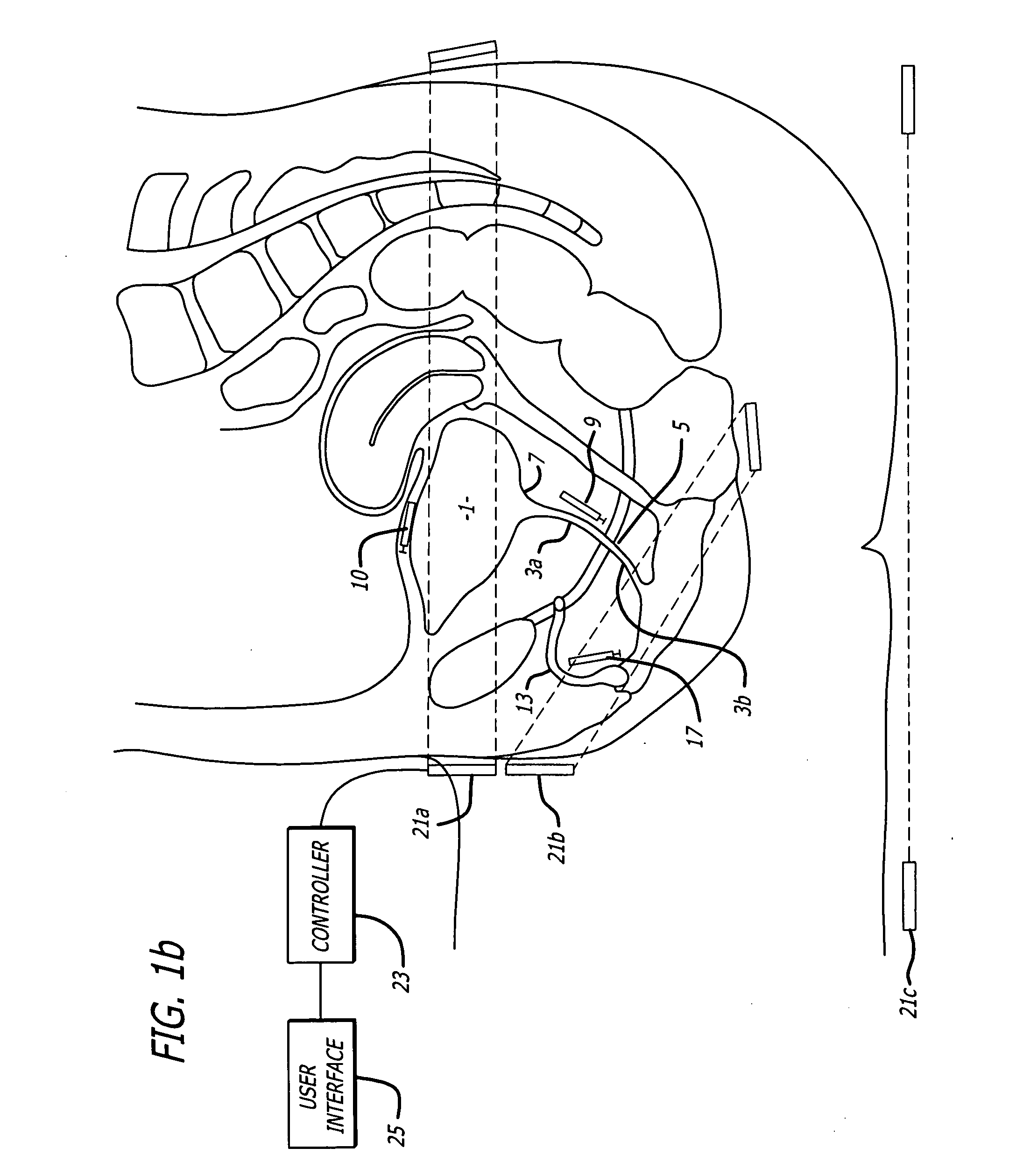 Method and apparatus for the treatment of urinary tract dysfunction