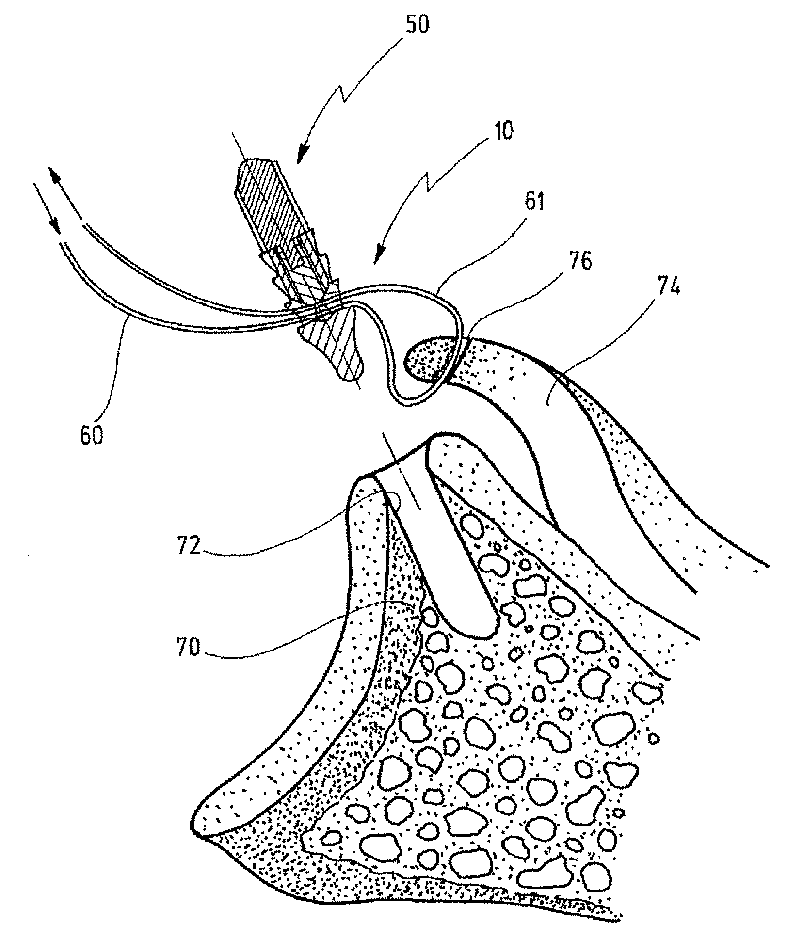 Anchor Element For Knotless Fixing Of Tissue To A Bone