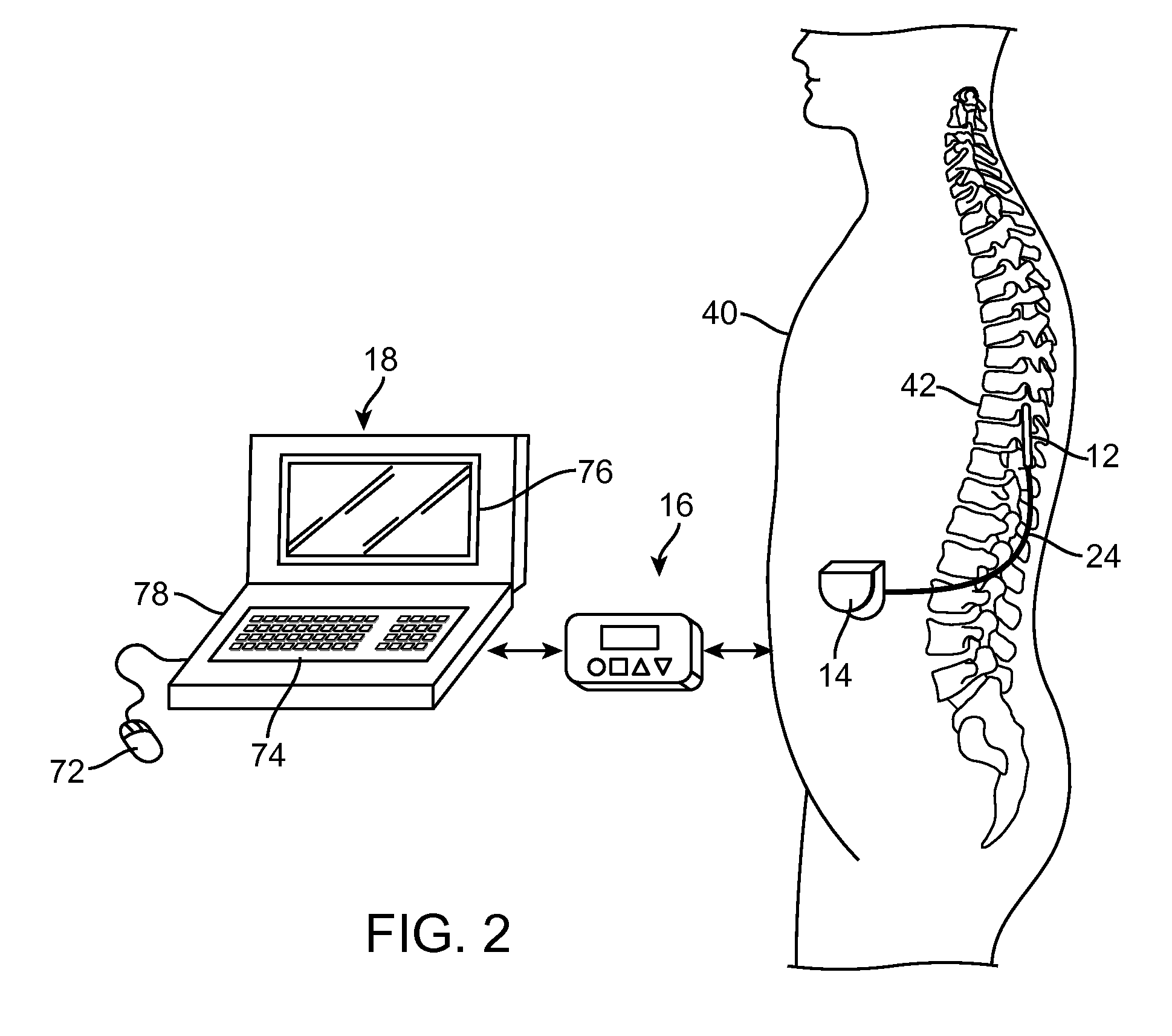 Neurostimulation system for matching ideal pole spacing with effective electrode separation