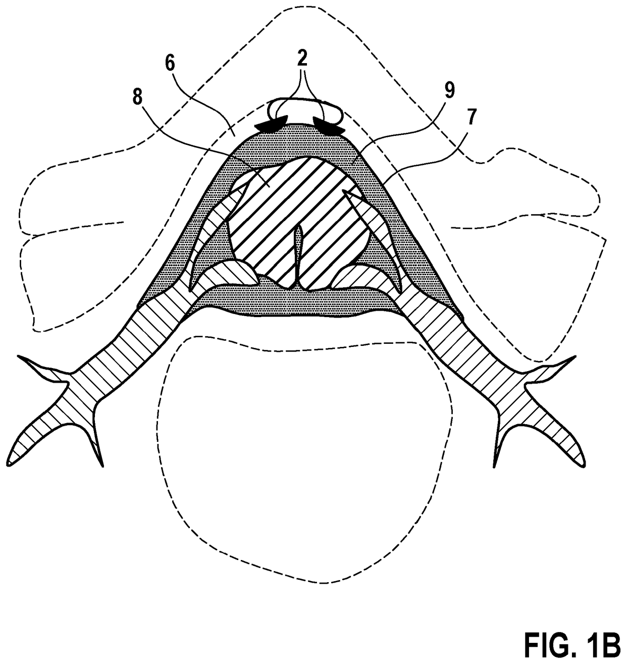 EP4479127B1 patent drawing